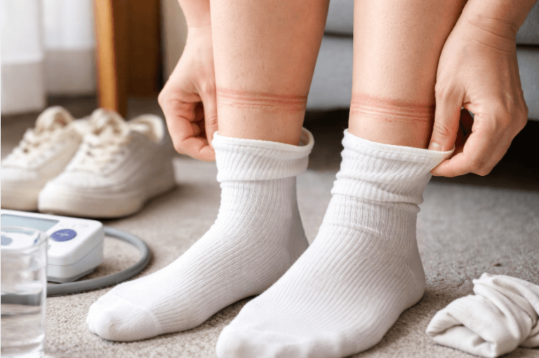 양말 벗은 뒤 종아리에 남는 ‘선명한 자국’… 심장·신장 질환 신호일 수도 양말 벗은 뒤 종아리에 남는 ‘선명한 자국’… 심장·신장 질환 신호일 수도